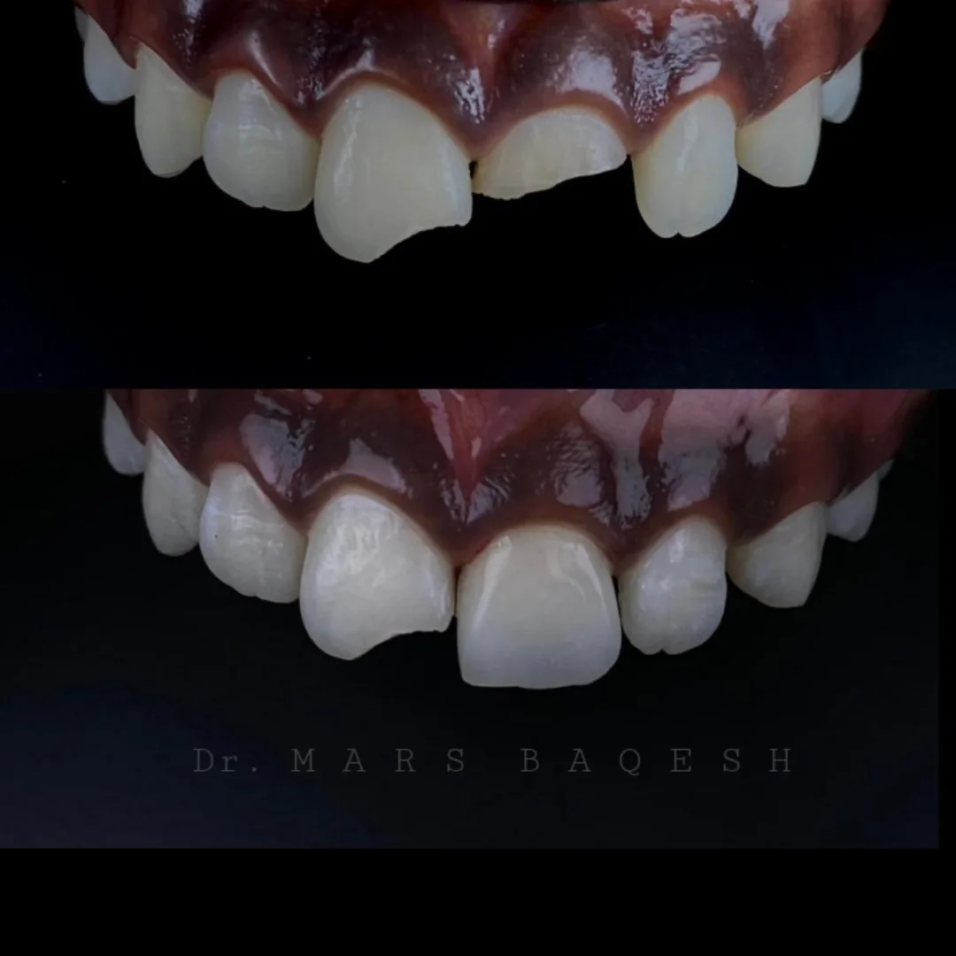 Composite Restoration